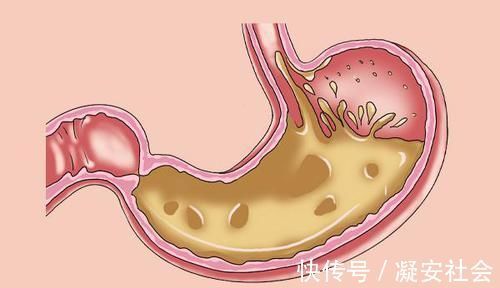 山楂|陈皮有“良配”，经常拿来一起泡水喝，养肝排毒，调血脂滋养脾胃