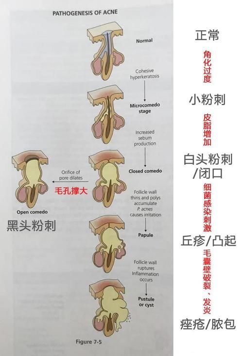 毛孔|闭口痘痘能做哪些皮肤管理？