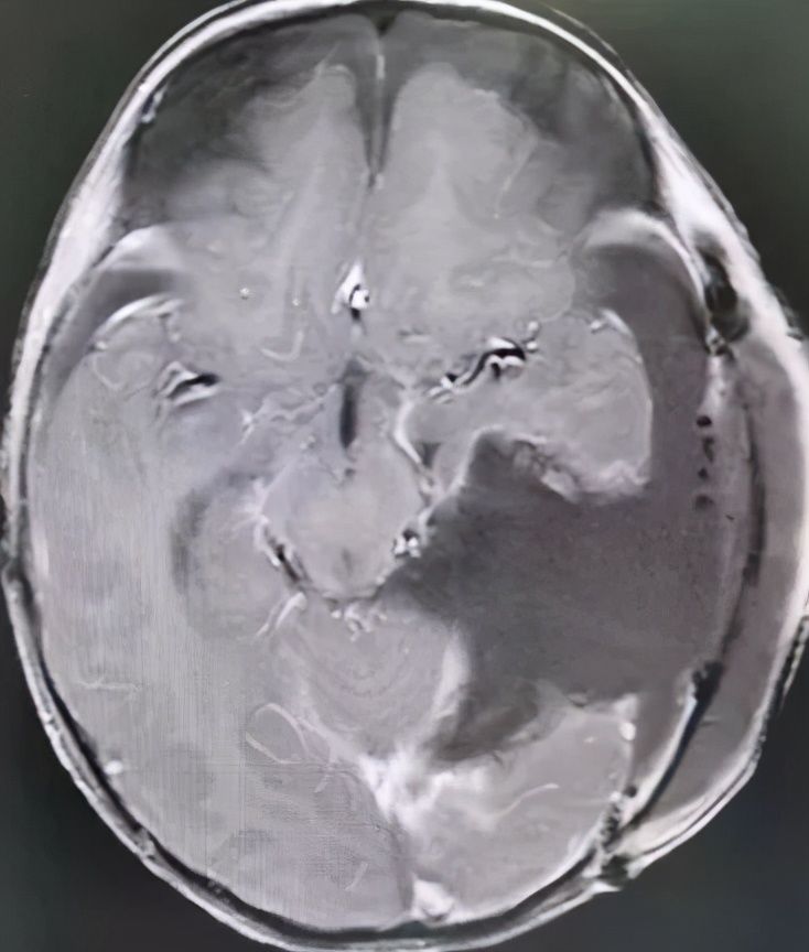 折翼天使们|2岁就查出肿瘤！这些让人心疼的折翼天使们，后来怎么样了？