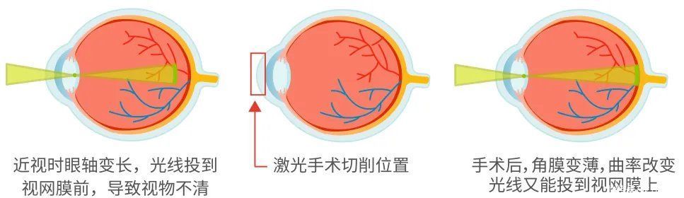 角膜|近视手术该不该做?怎么选?一文给你讲清楚