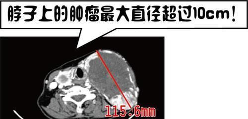 “俩头”在脖子上长了20年！直到喘不上气才看医