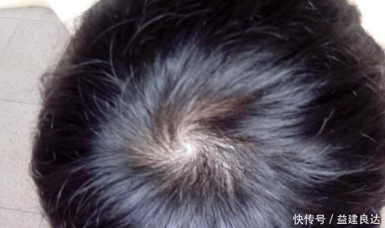 女孩|“双顶男孩找不到,双顶女孩没人要”,孩子头上的“旋”代表了啥