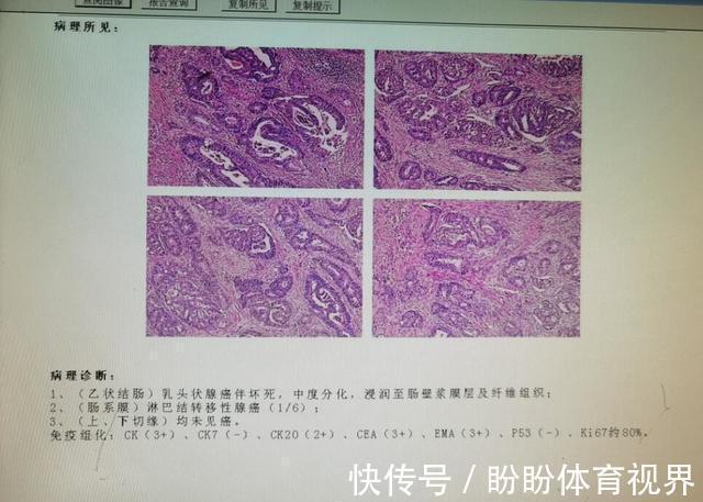 结直肠癌|出现便血，是肠癌还是痔疮？医生教你从三方面辨别，别再混淆了