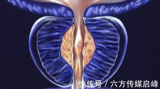 病因|20岁男子尿频尿急一年多,医生:做好以下3点,前列腺炎不复发