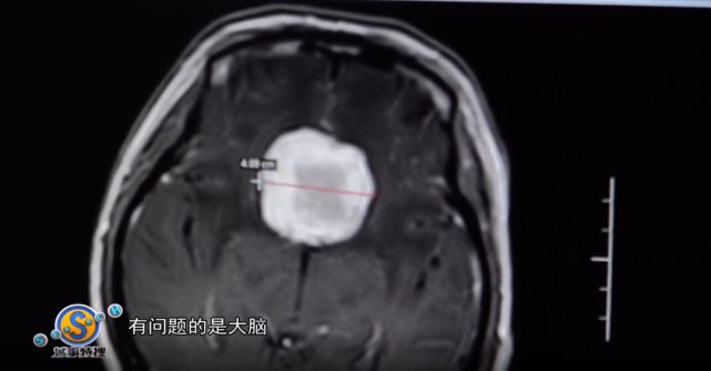 脑部|女子眼睛“起雾”险丧命，一查惊呆，问题竟出在脑部