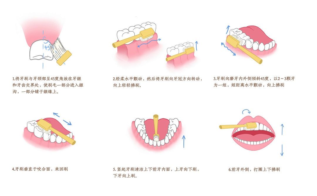 预防|你知道牙周炎的病因、危害和预防吗？