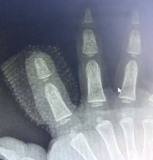  兔子|1岁男童被兔子咬断手指，家人杀兔取指为时已晚，表示3天没喂过