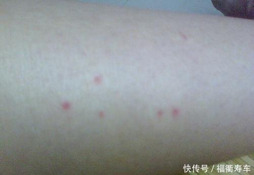 身上长了许多 小红点 可能是身体发出的 求救信号 快资讯 身上长了许多 小红点 可能是身体发出的 求救信号 快资讯