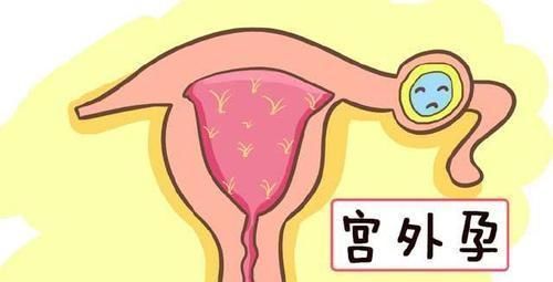 宫外孕|女人怀上“宫外孕”,多半是男人的锅妇产科医生几句话挑出问题