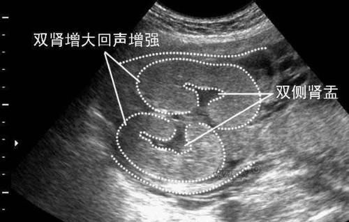 B超单上“肾盂分离”，是暗示性别吗？看完就不会一知半解了