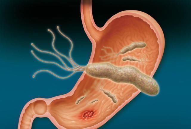 幽门螺杆菌最怕的5样食物已找到,每天换着吃,远离胃溃疡和胃癌