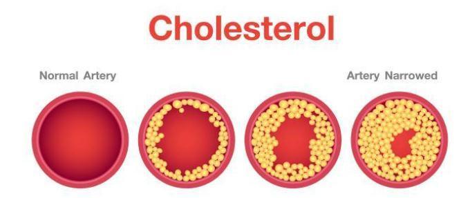 斑块|冠心病,是由什么原因引起来的?听听医生怎么说