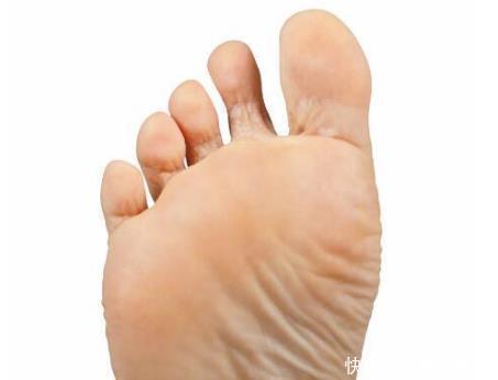 纹路|肝病被称为“冷漠杀手”,脚部出现4种不良表现,肝多半出问题了