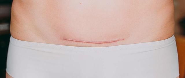 外科手术|剖腹产时,伤口缝线处理是用美容线好还是拆线的好?