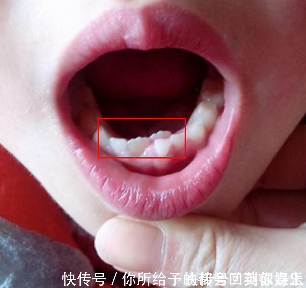 恒牙|6岁男娃长“双层牙”,老人的“坏习惯”害了娃,你家有这习惯吗