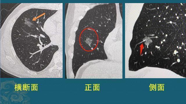 黄勇|肺腺癌是怎么长出来的医生介绍3类肺结节，像种子发芽