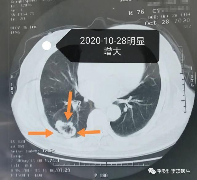 肿瘤|肺癌的治疗要花多少钱?晚期肺癌还有必要治疗吗?