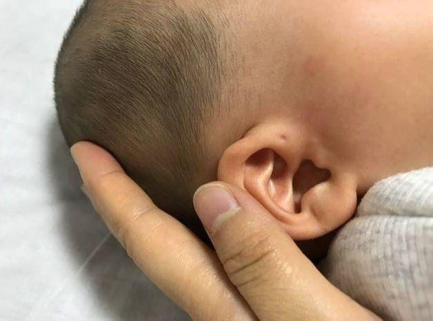 发炎|娃耳朵上的“小孔”是聪明洞医生通常不会明说,妈妈要心知肚明