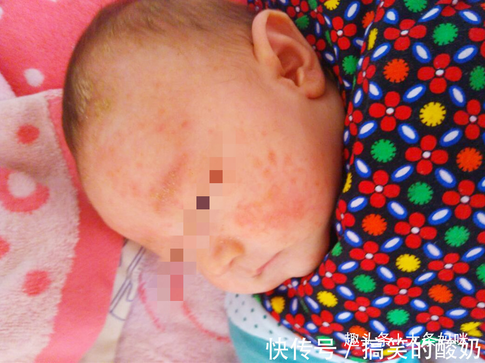 婴幼儿|十个妈妈九个愁，恼人的婴幼儿湿疹，到底应该怎么“破”