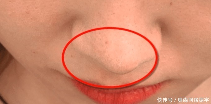 女生|18岁女生不满隆鼻效果想退款，医院直接拿出术前照：你这是敲诈