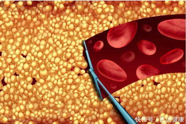 高血脂不控制,当心引发这9种并发症,每个都不能忽视