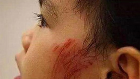 剪刀|4年前因吃奶太用力,被妈妈用剪刀划伤脸的男婴,现状如何了?