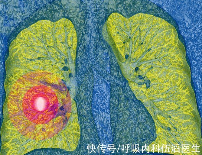 毛玻璃|查出肺结节，就意味着癌变的前兆吗？一名肺结节患者的亲身经历