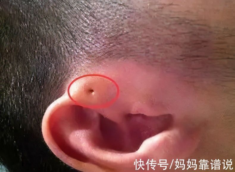 小孔|3岁男童耳边长“聪明孔”,奶奶用手挤,却害了孩子