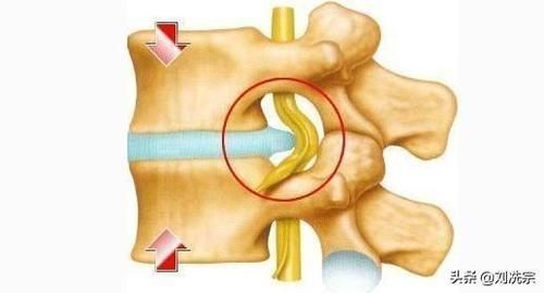 腰椎管矢状径图片