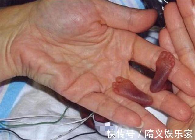 阿米利娅|世界上最小的婴儿，放在手心比巴掌还小，现在变成了这个样子