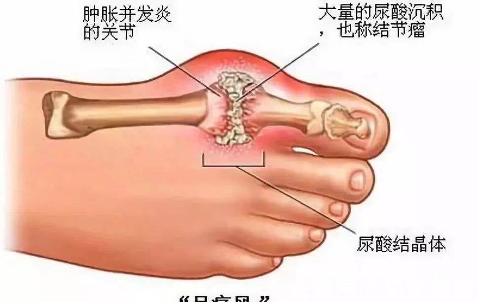 痛风|高血压、高血糖、高血脂、高尿酸不能吃啥?50岁以后应人手一份!