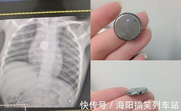 坏毛病|5岁女童莫名暴瘦,妈妈的一句“我女儿没戴项链”,惊醒了医生