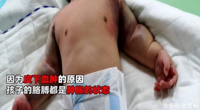 新生男婴三天后患“怪病”，一碰就出血！满身淤青让人心疼