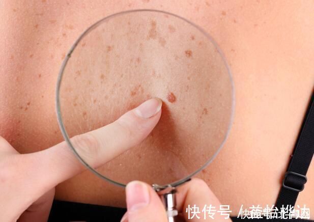 皮肤|皮肤出现4种症状,或是肝出问题了,趁早查一下