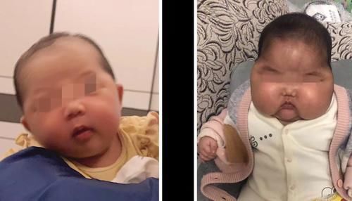 湿疹|婴儿霜激素超标,孩子俩月变大头娃:宝宝湿疹,我用过的绿色疗法