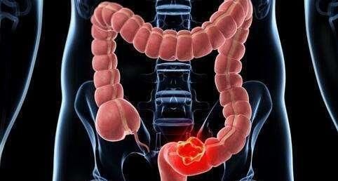 预防肠癌|肠道开始癌变,入厕时会有3种表现,若一个不占,说明肠道很健康