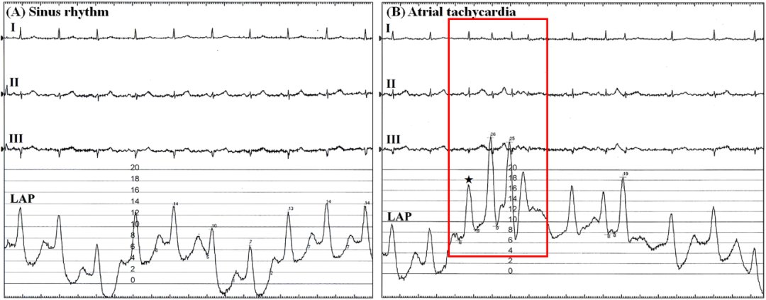 心电图|一说话就心脏乱跳！这个全球不到10例的罕见心动过速病例，了解一下