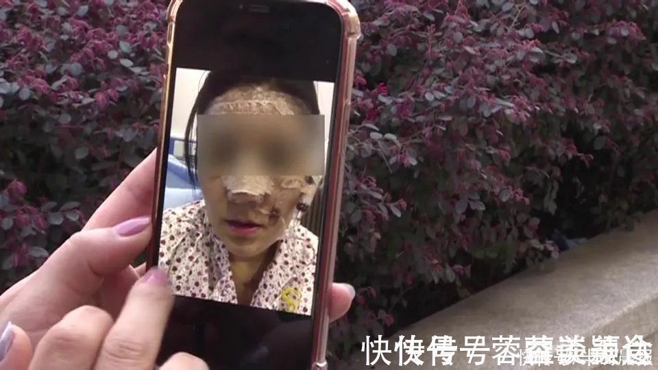 鼻子|花了近4万!女子取肋骨做的“欧美鼻”却变“妈生鼻”
