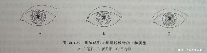 重睑术是什么？俗称割双眼皮，双眼皮手术