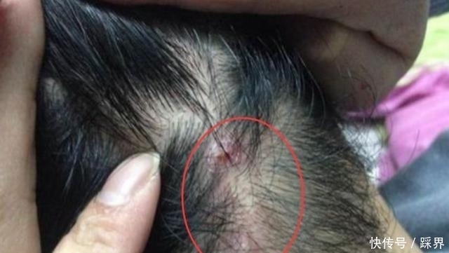 脱发多是拖出来的,一旦头上有4种迹象,