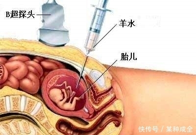 风险|羊水穿刺并不可怕，生一个不健康的宝宝才是悔了他一生！