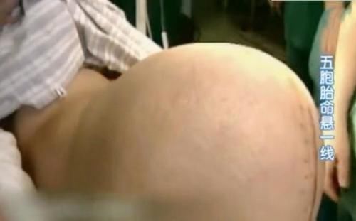 5胞胎|中国首例“5胞胎”长大了,如今已满18岁,家庭状况令人感叹