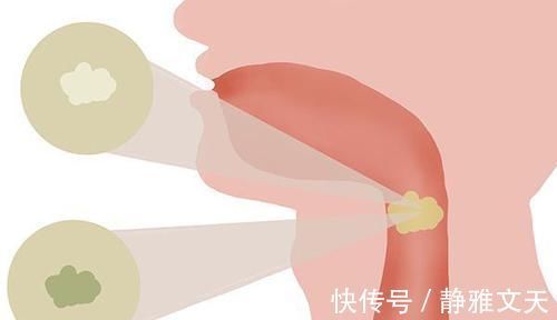 咳嗽|肺癌引起的咳嗽,与普通咳嗽有啥不同呼吸科医生,教你正确分辨