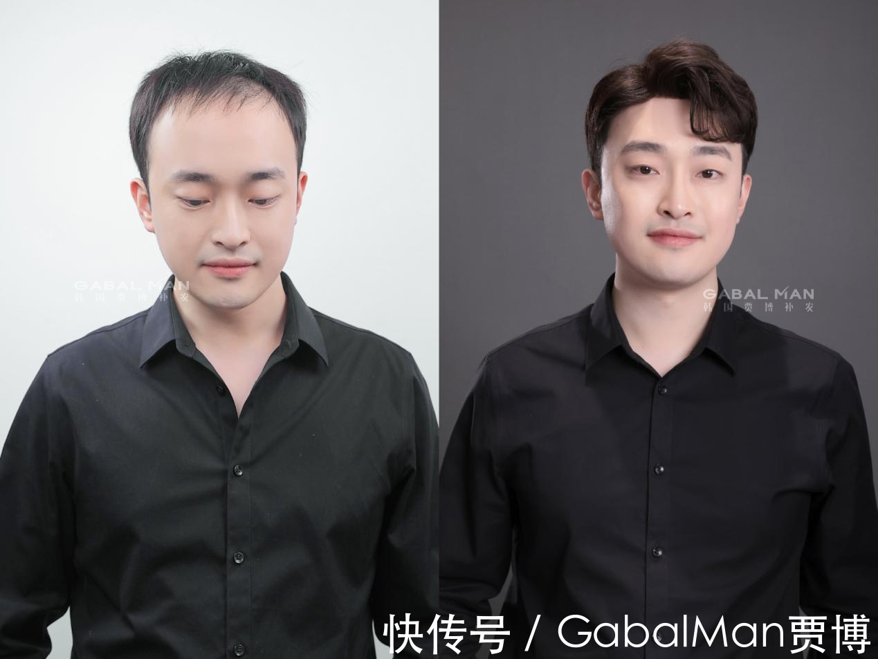 地中海|地中海发型和戴假发,你更不能接受哪个?