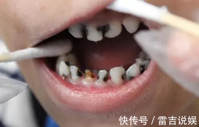 刷牙|让孩子“烂牙”的不是糖,是家长无知!3种错误行为,一定要避免