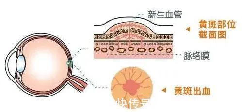 防范|权威提醒:近视度数不断增加或致盲,高度近视需引起重视和防范