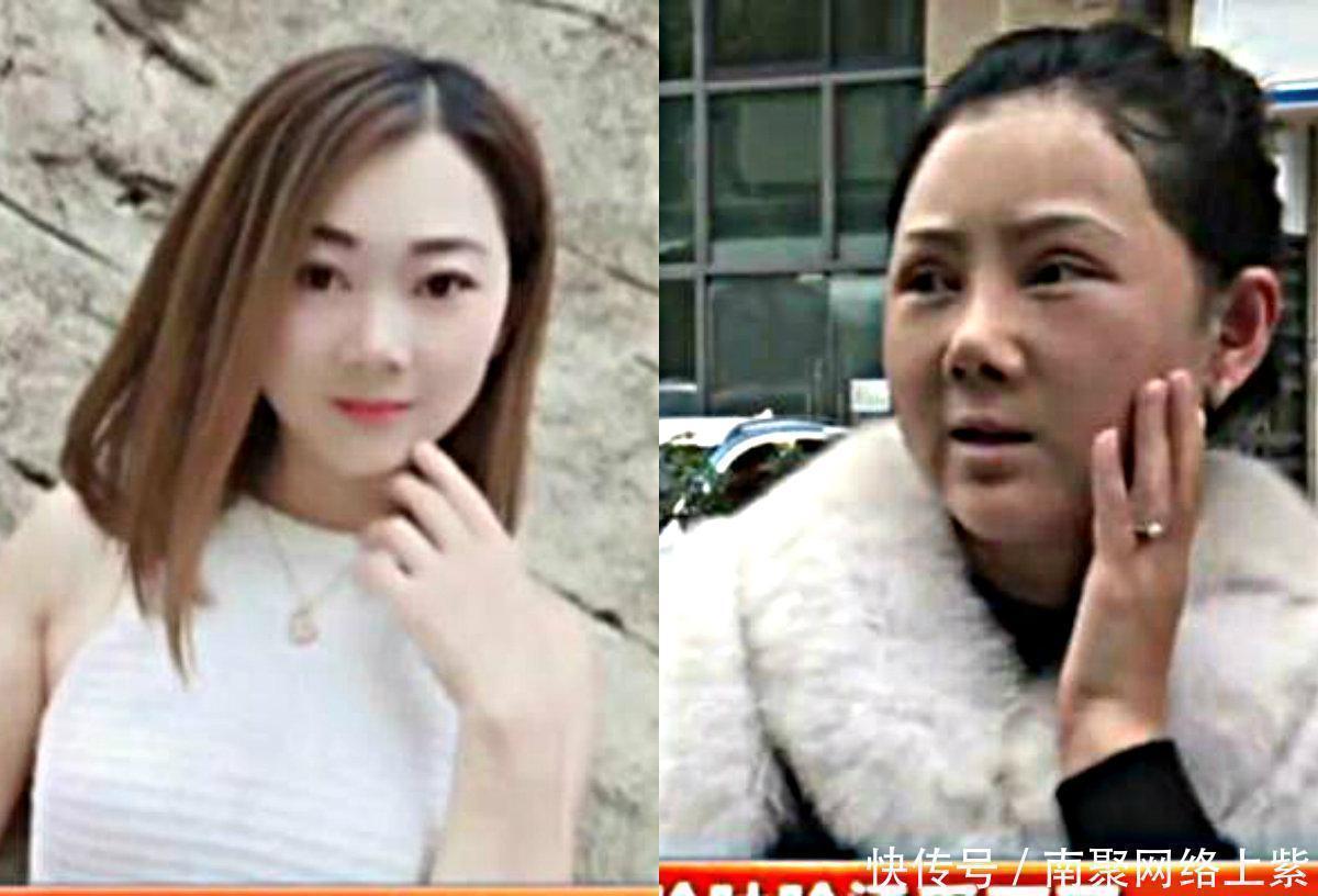 大妈|女子花9万元整容, 却脸肿脸烫的受不了, 如今完全像50岁大妈