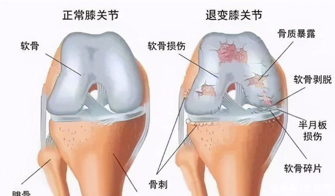  疼痛|冬天做好这3点，让你的膝盖远离疼痛
