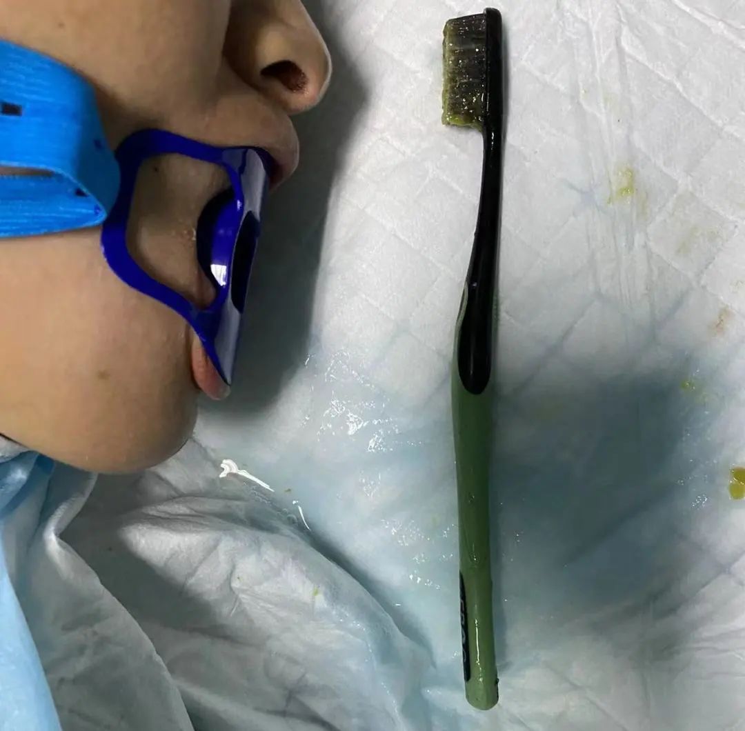 吕锋|惊呆!女子刷完牙漱口,整支牙刷竟掉进胃里