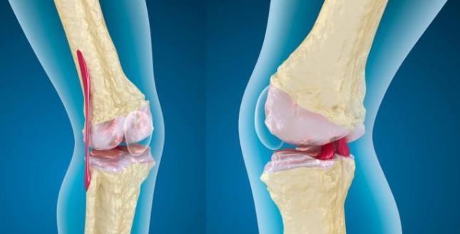 骨质疏松的克星被发现,经常吃点,增加骨密度,骨质疏松不攻自破